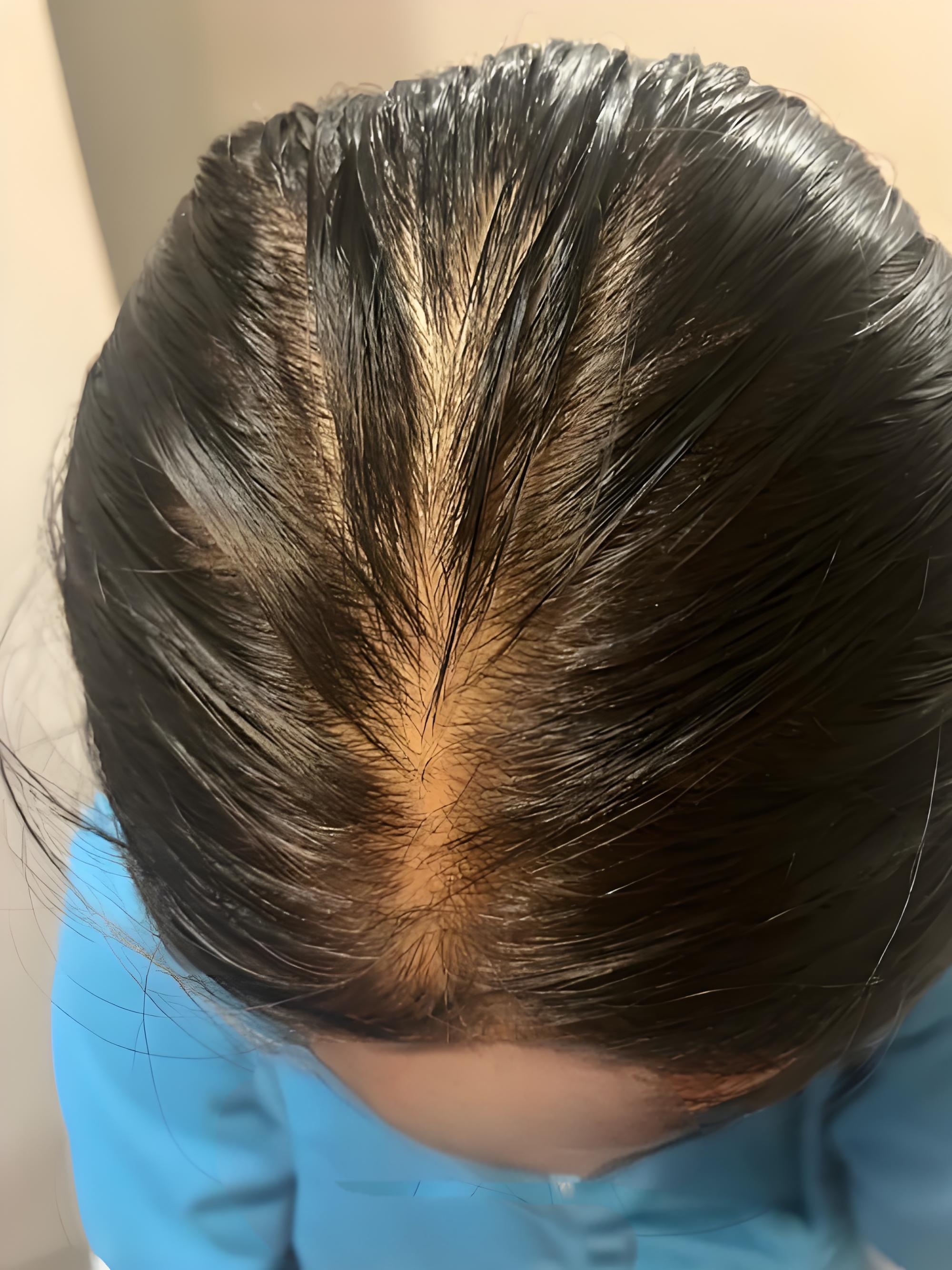 90 后总该是意气风发的模样可长期熬夜学习高压备考让我的头发成了