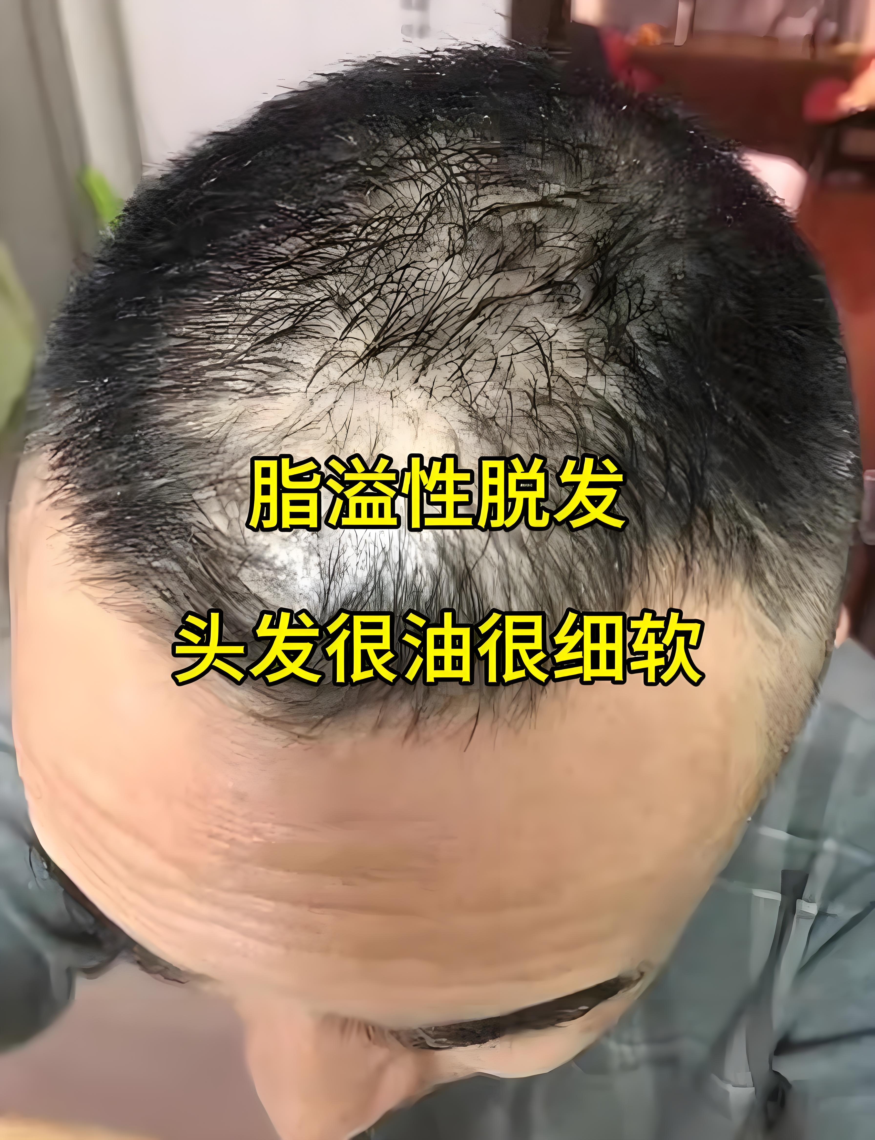 头发再生最有效的方法