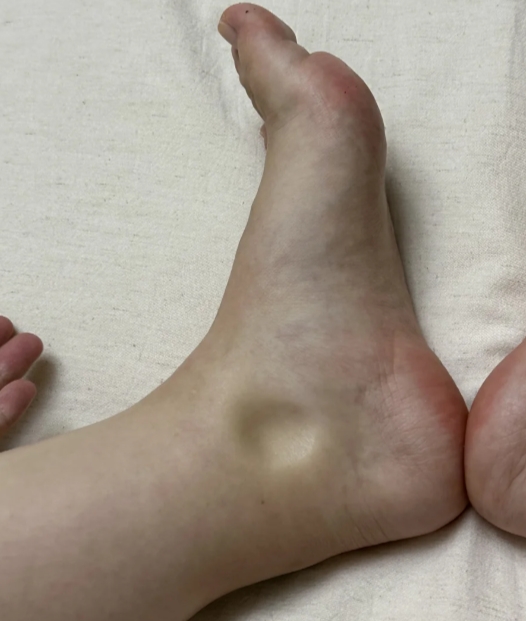 一文看懂肾健康警示 孕期水肿十分常见,但有时并非单纯的生理现象