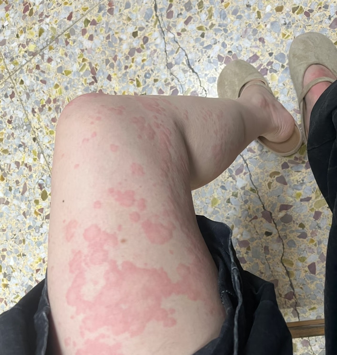 鬼风疙瘩图片食物过敏红疹图片哌拉西林过敏皮疹图片过敏有哪几种情况