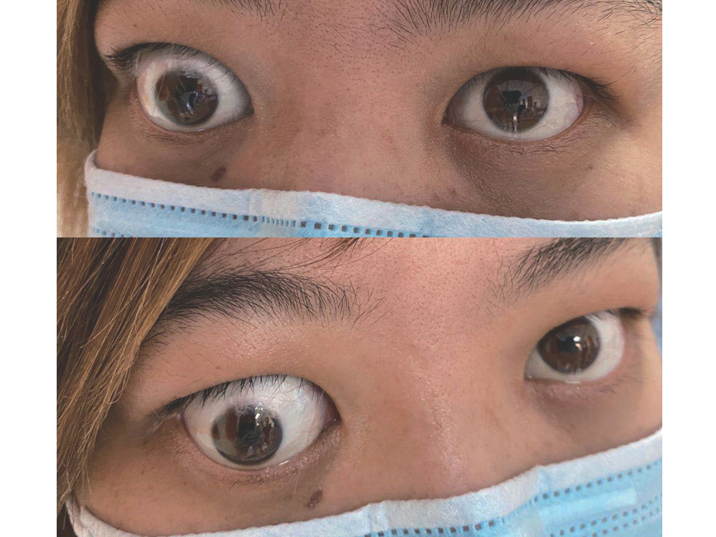 4甲状腺突眼对比案例甲减眼睛脆骨病人长眼睛眼球突出甲亢甲状腺抗争