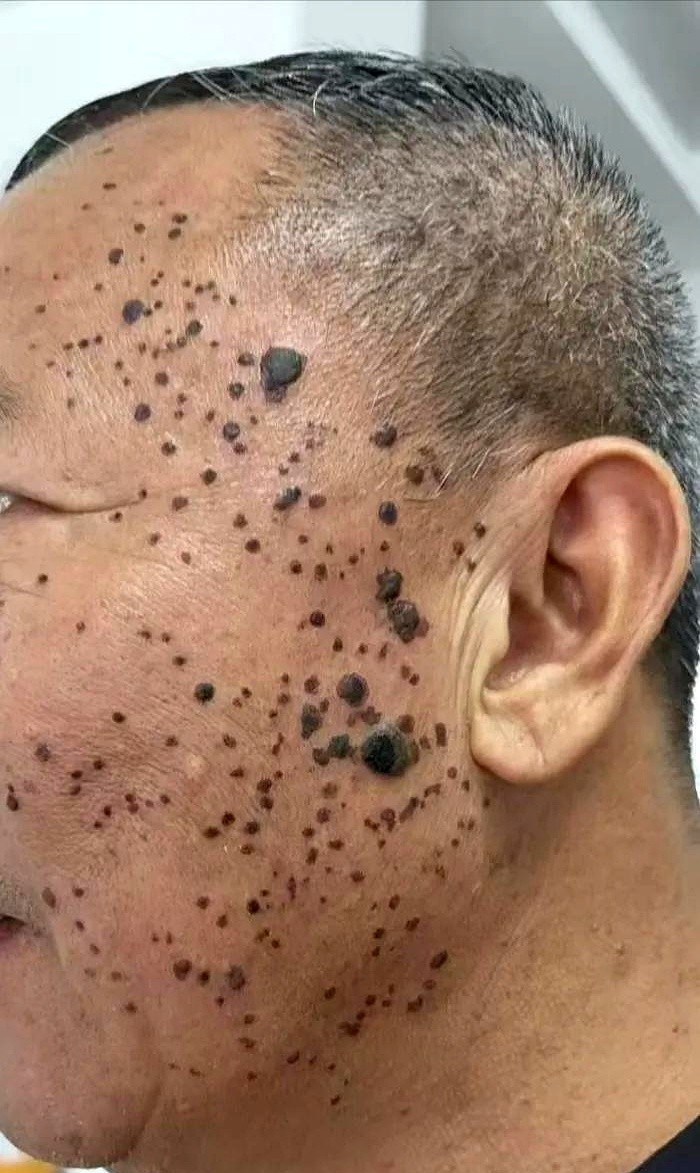 是什么原因老人斑癌老人脸上出现黑斑是什么原因疣黑斑老年痣图片脸上