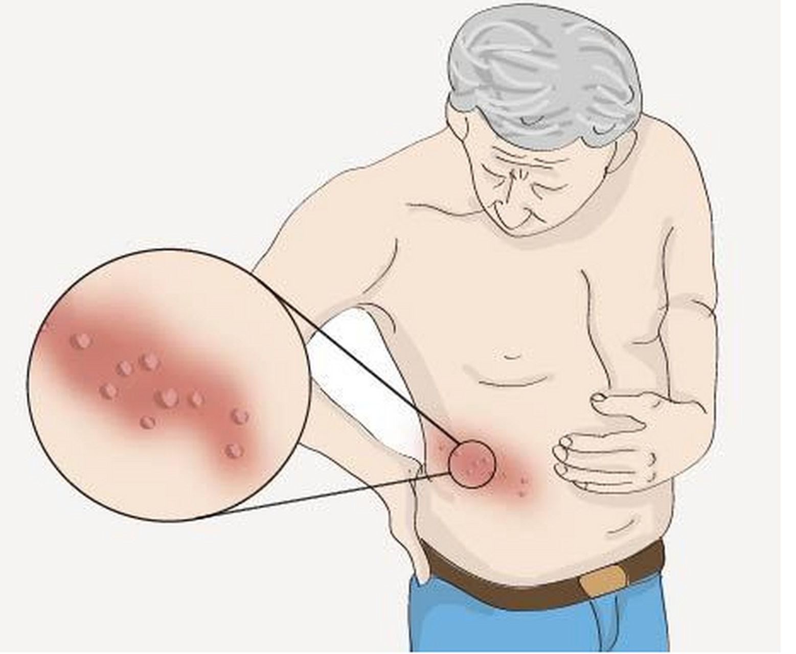 带状疱疹图片卡通图片