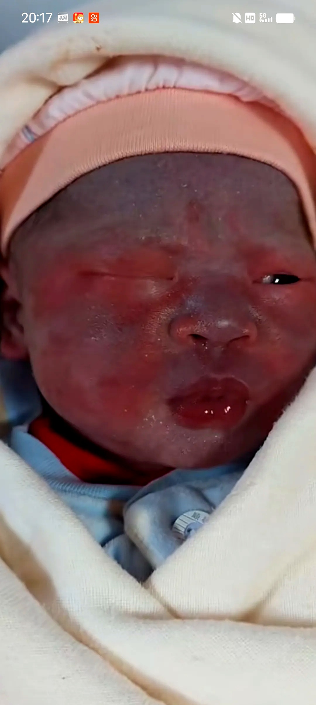 刚出生的宝宝脸上出现一块块红斑,新手妈妈伤心地哭了