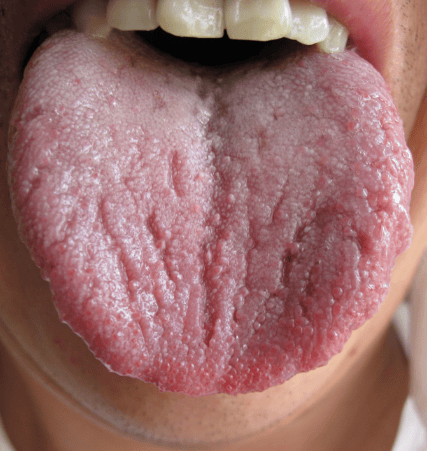 象十分典型:舌体布满深裂纹,就像干涸龟裂的土地,舌质红绛,舌苔少而干