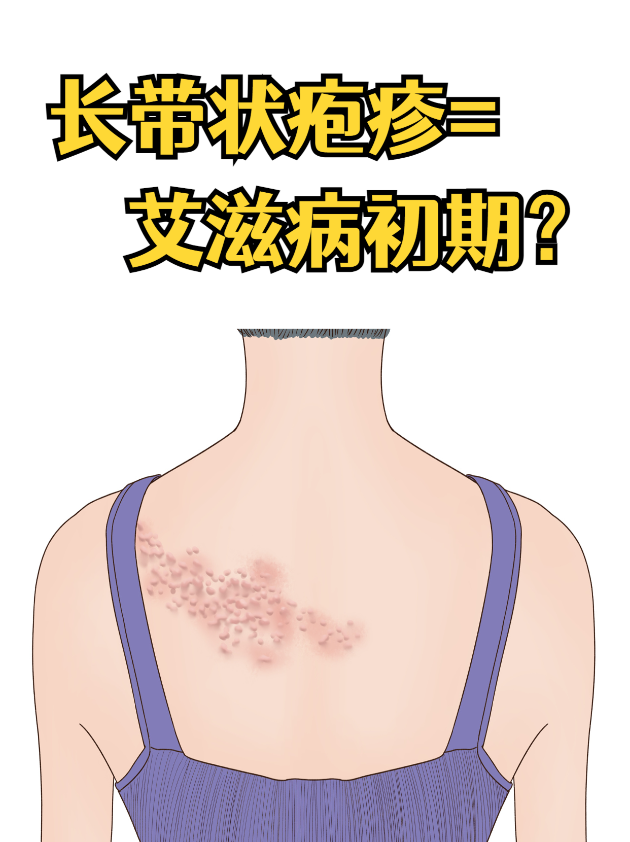 长带状疱疹 = 艾滋病初期?别混淆!
