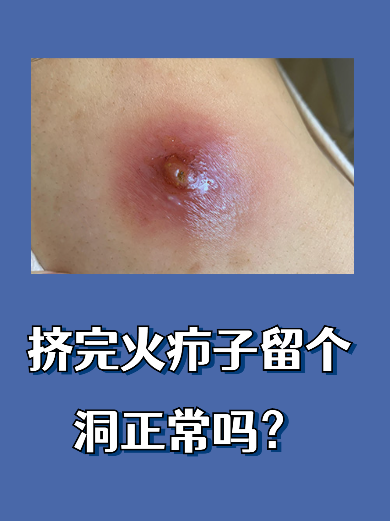 挤完火疖子后留下小洞,是皮肤组织修复过程中的常见现象,但需根据洞