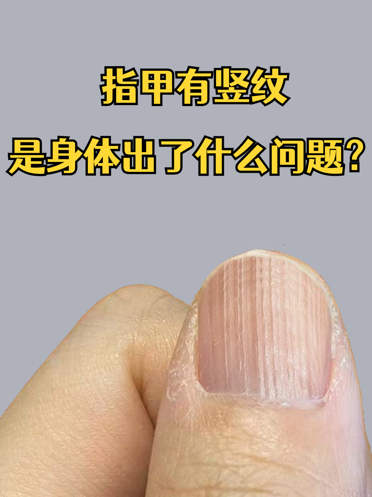 指甲有竖纹是身体出了什么问题?