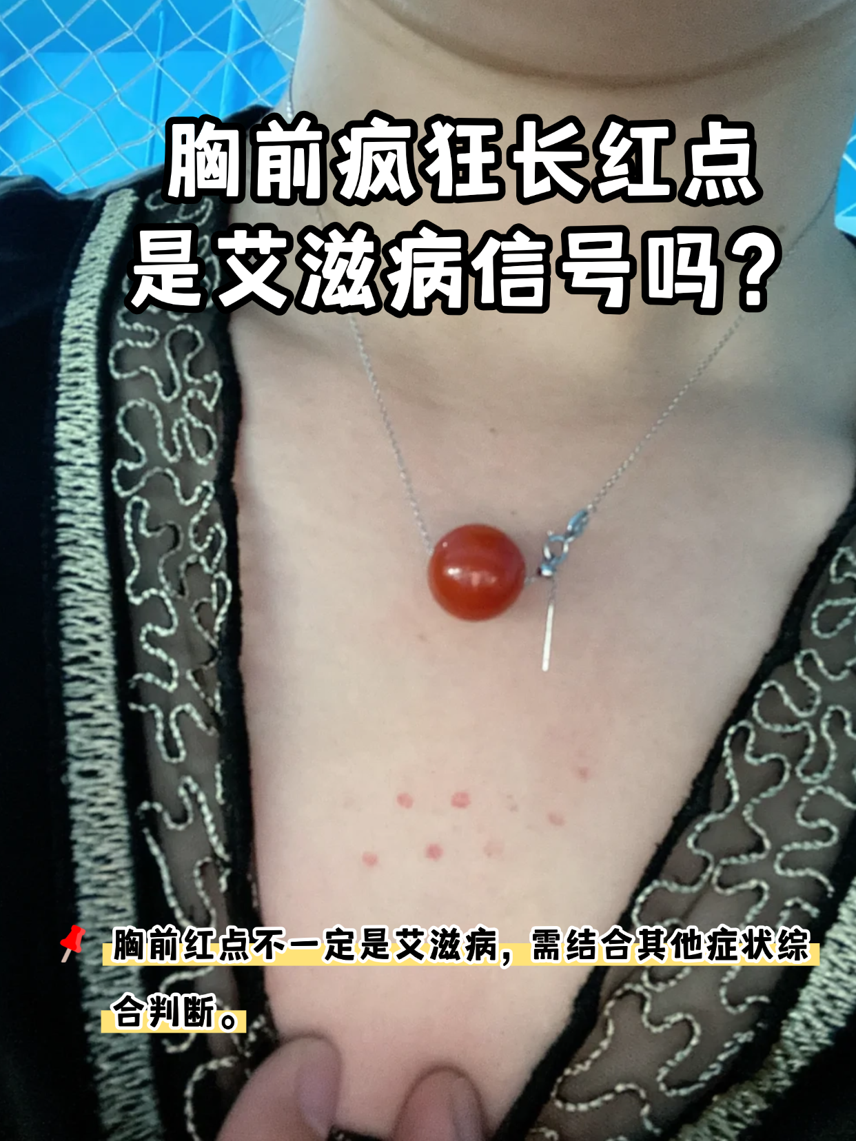 胸前红点不一定是艾滋病,需结合其他症状综合判断 艾滋病急性期可能