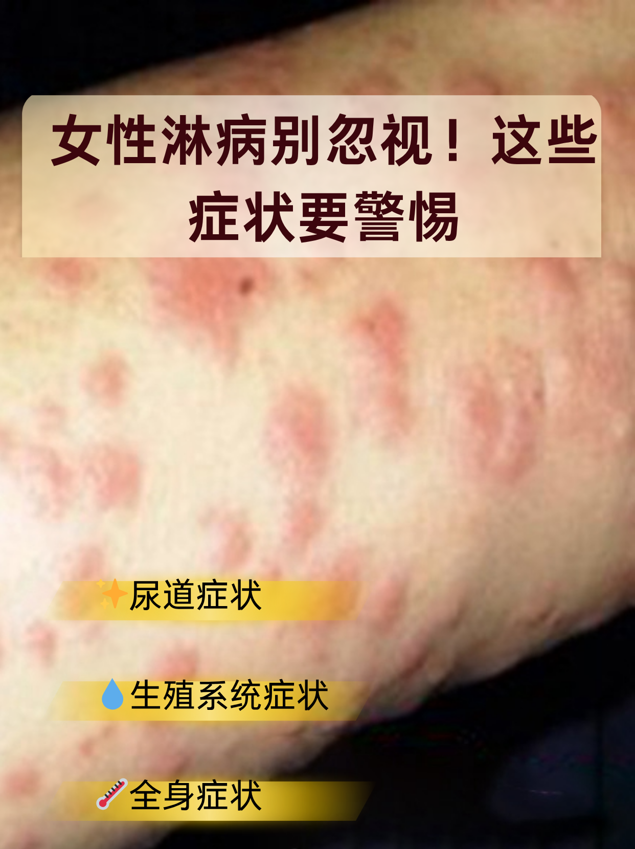 今天就来详细说说女性淋病的症状表现和关键注意事项