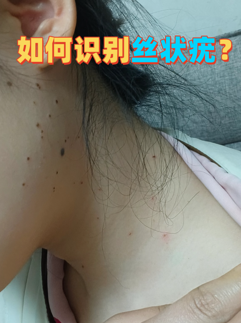 脖子上的小肉条确实可能是丝状疣,但也可能是其他皮肤问题