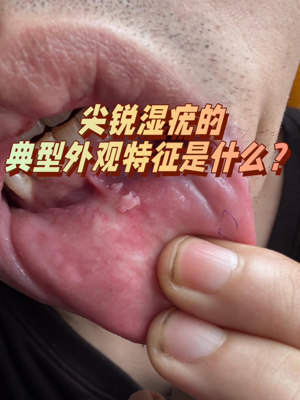 尖锐湿疣的典型外观特征是什么?