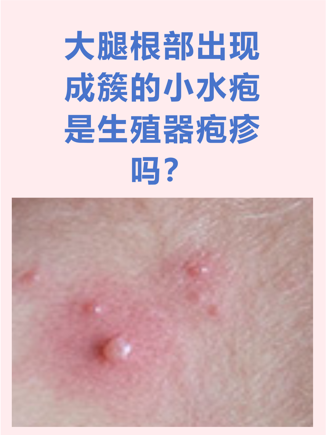 大腿根部出现成簇的小水疱是生殖器疱疹吗?