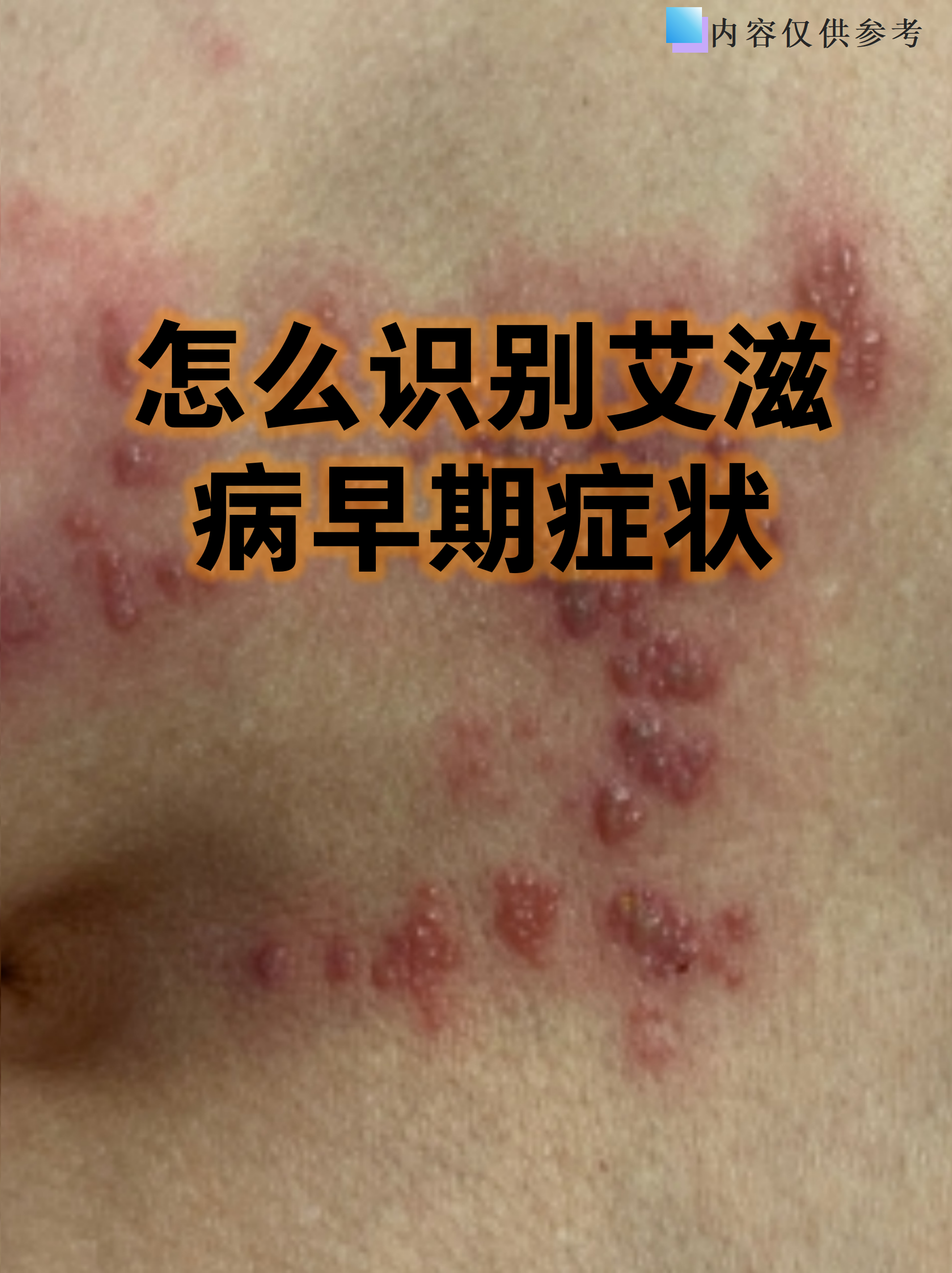 怎么识别艾滋病早期症状