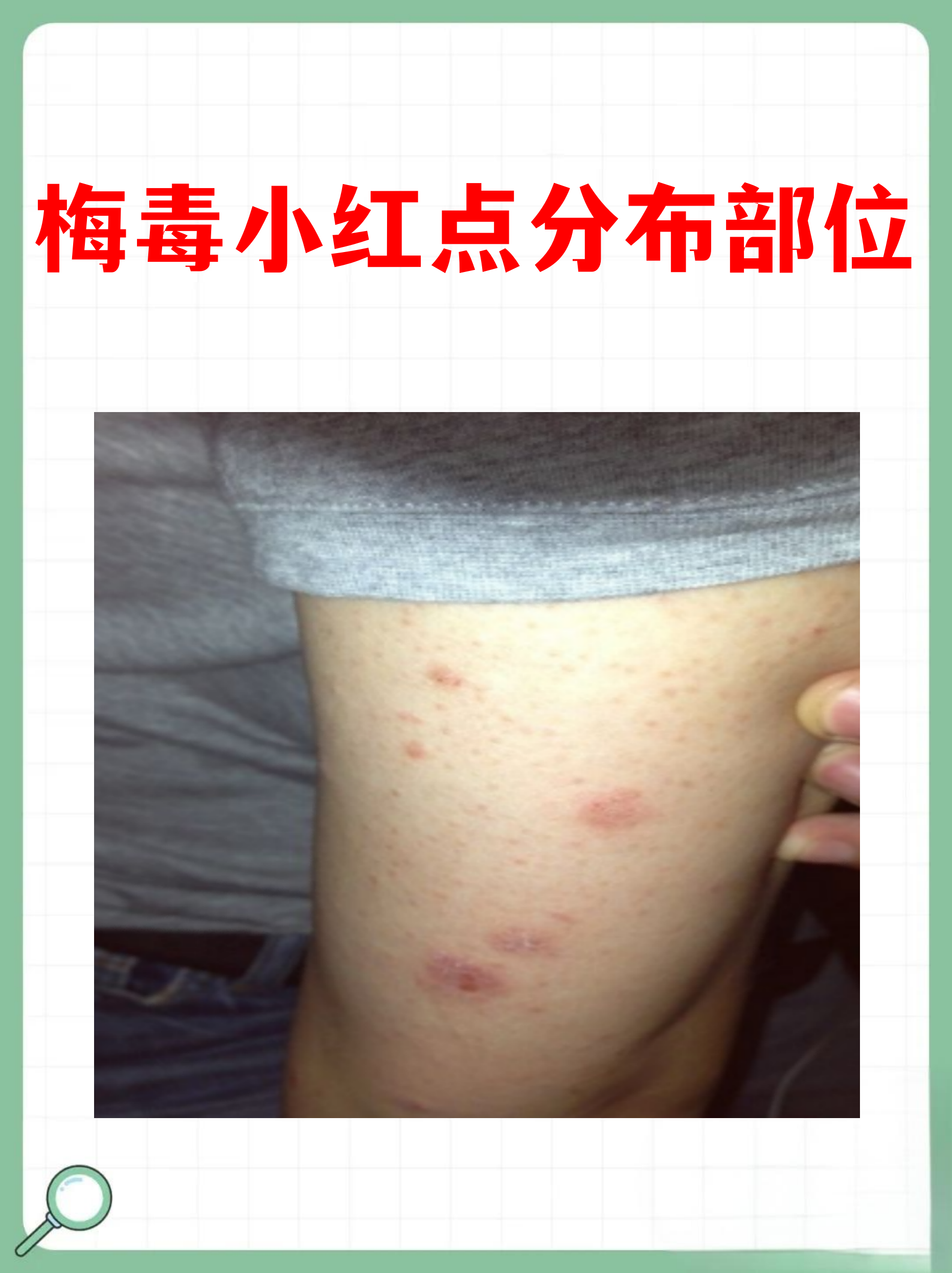 梅毒小红点通常出现在手掌,足底等部位,这种特征