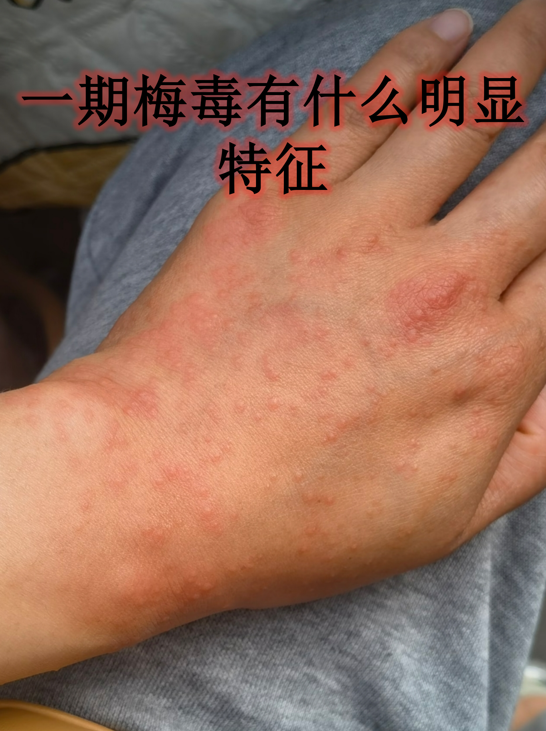 一期梅毒典型特征 硬下疳特点:硬下疳是一期