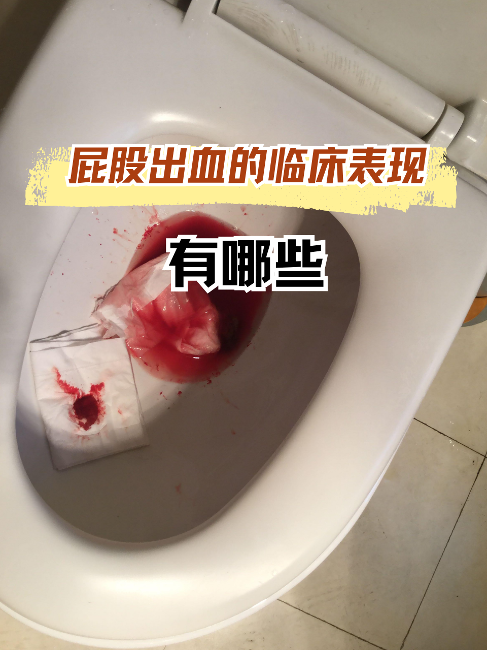 拉屎为什么擦屁股有血
