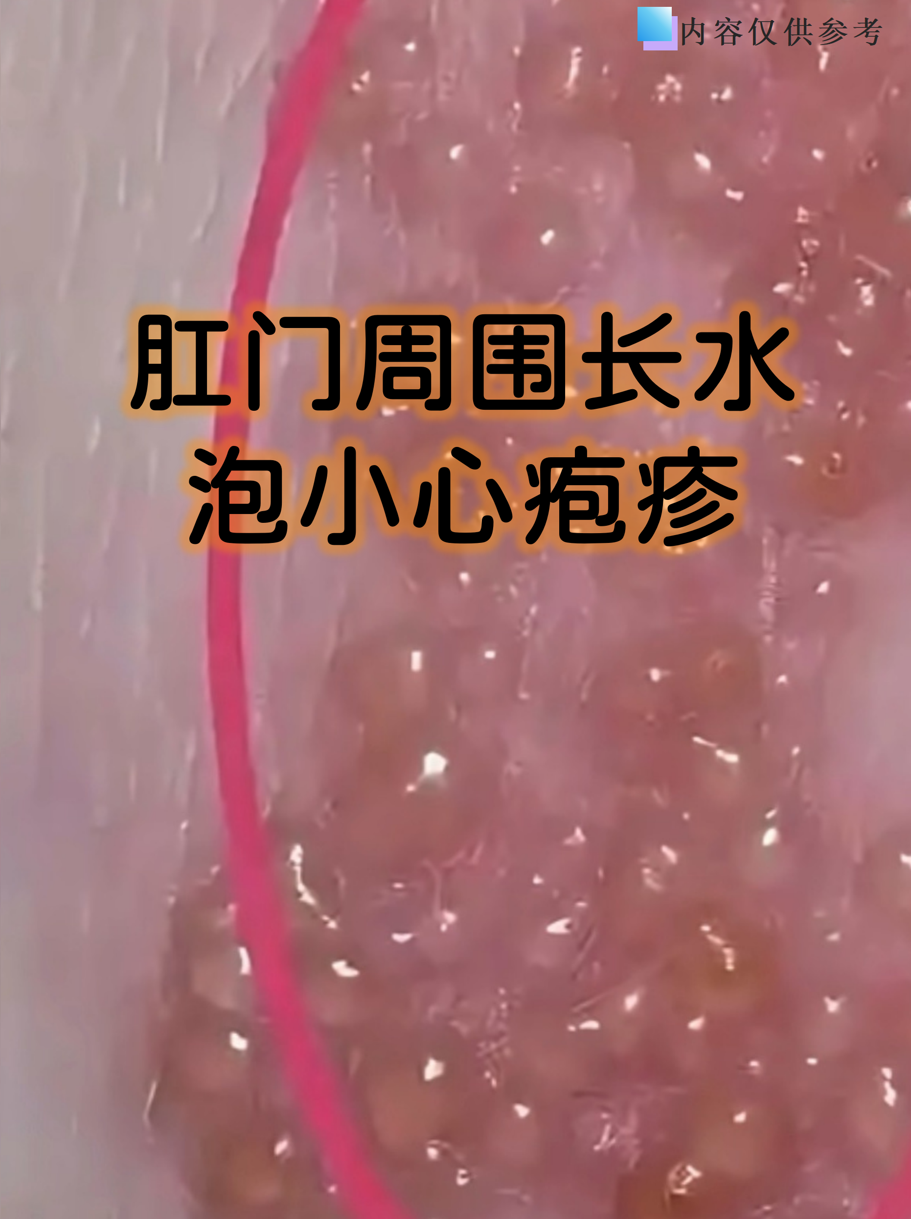 肛门周围长水泡小心疱疹