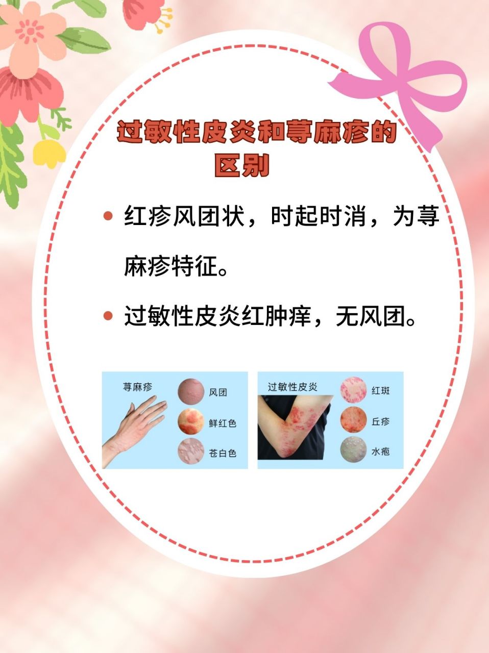 医生揭秘:揭秘过敏性皮炎vs荨麻疹   96定义不同   荨麻疹:皮肤小