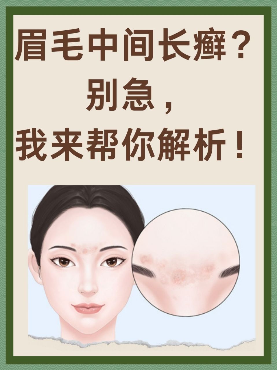 99697115关于眉毛中间长癣的原因,这可能是由于她近期免疫