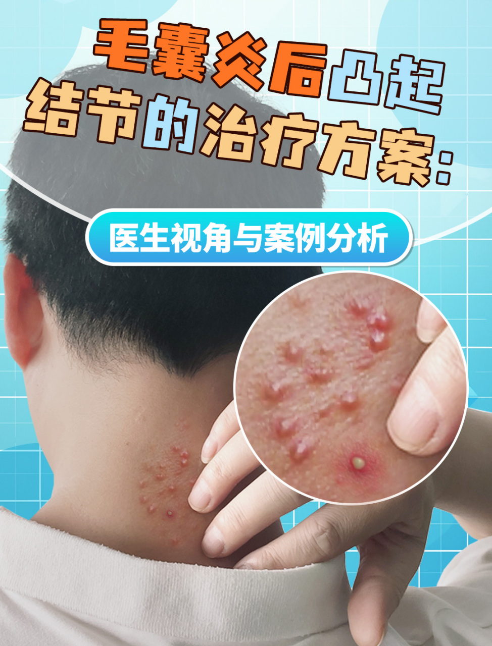 毛囊炎后凸起结节的治疗方案
