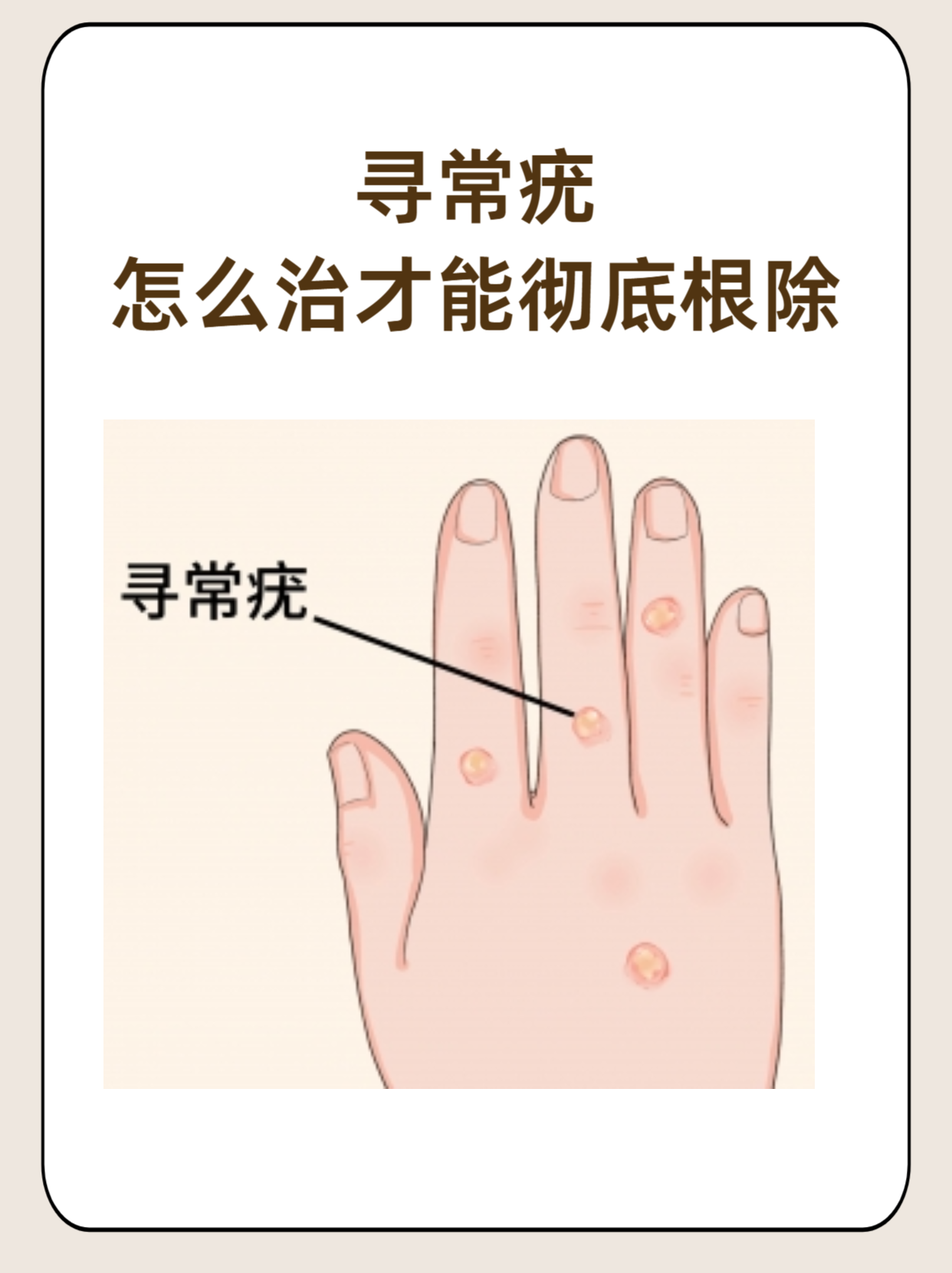 寻常疣怎么治才能彻底根除