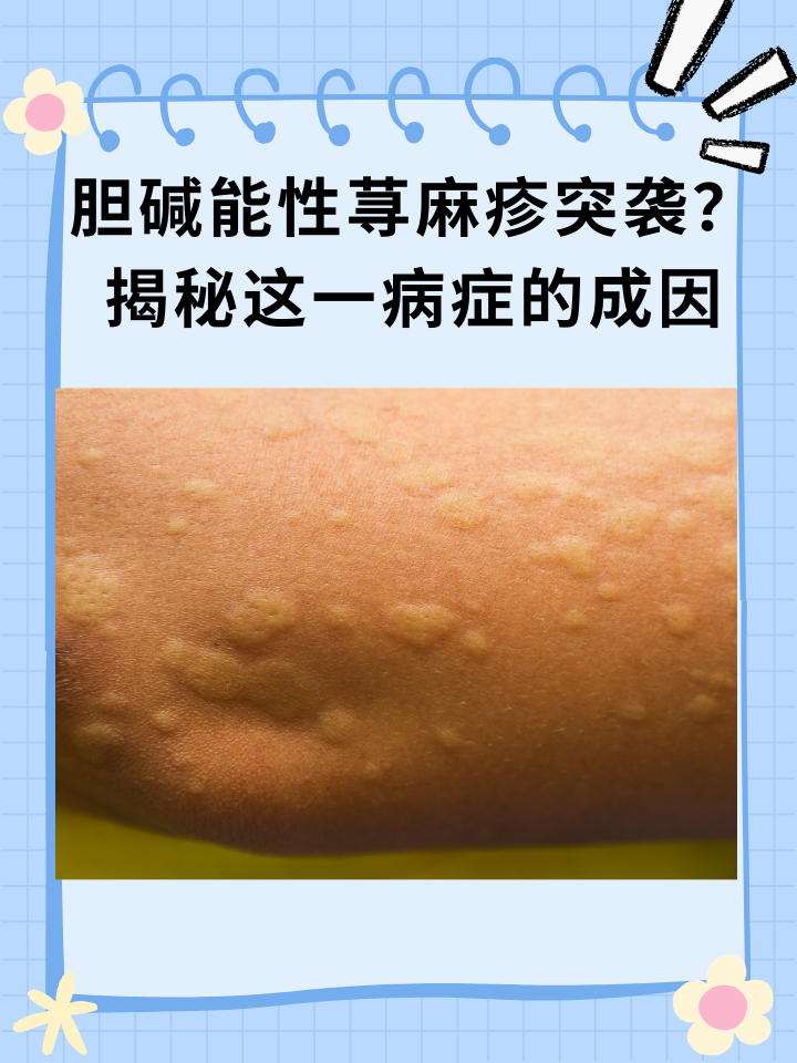 胆碱能性荨麻疹突袭?