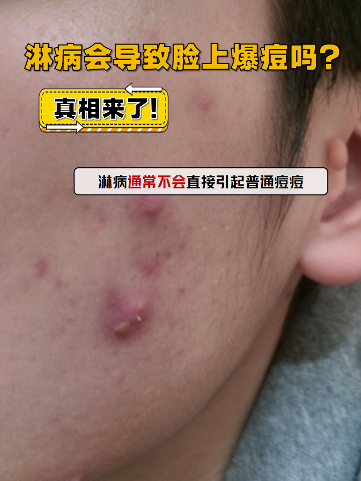 得了淋病脸上会冒痘痘吗?