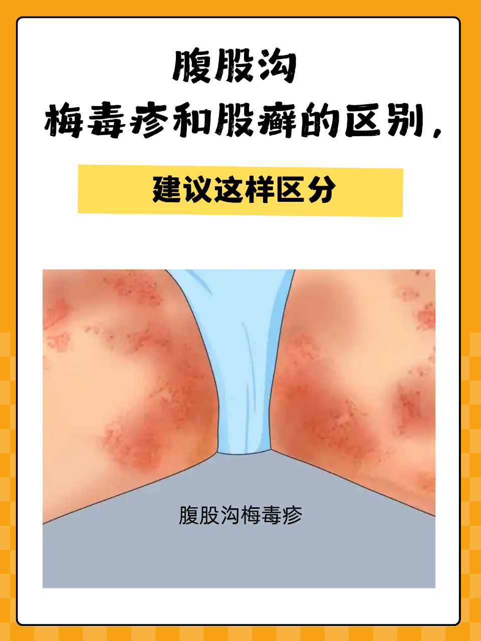 腹股沟梅毒疹和股癣的区别,建议这样区分