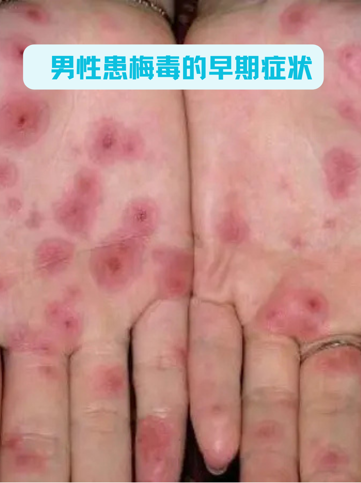 男性患梅毒的早期症状
