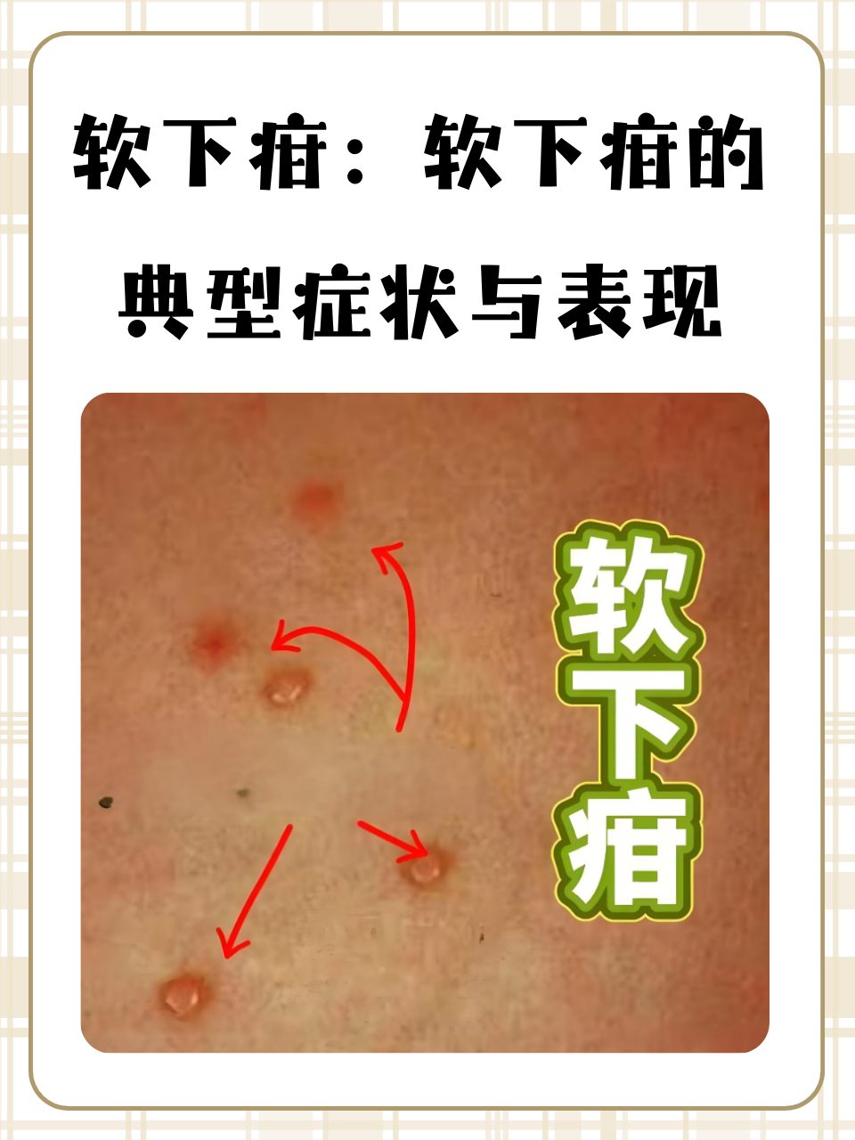 软下疳:软下疳的典型症状与表现