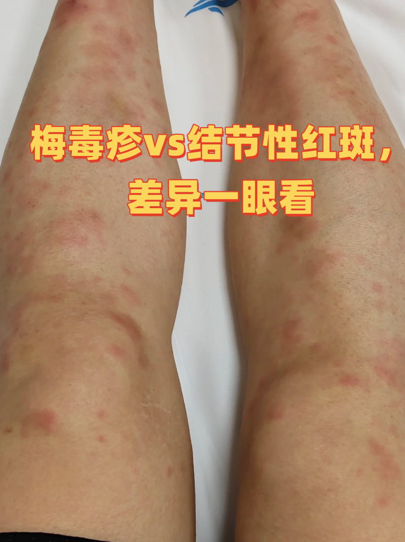 梅毒疹vs结节性红斑,差异一眼看