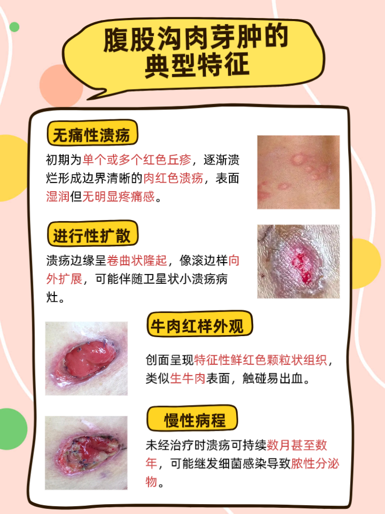 夏天出汗多,衣物摩擦频繁,腹股沟区域容易出现