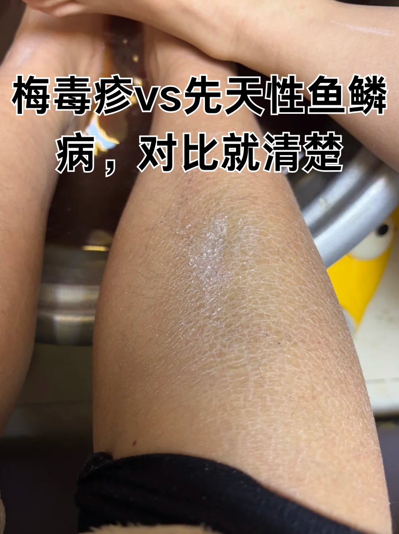 梅毒疹vs先天性鱼鳞病,对比就清楚