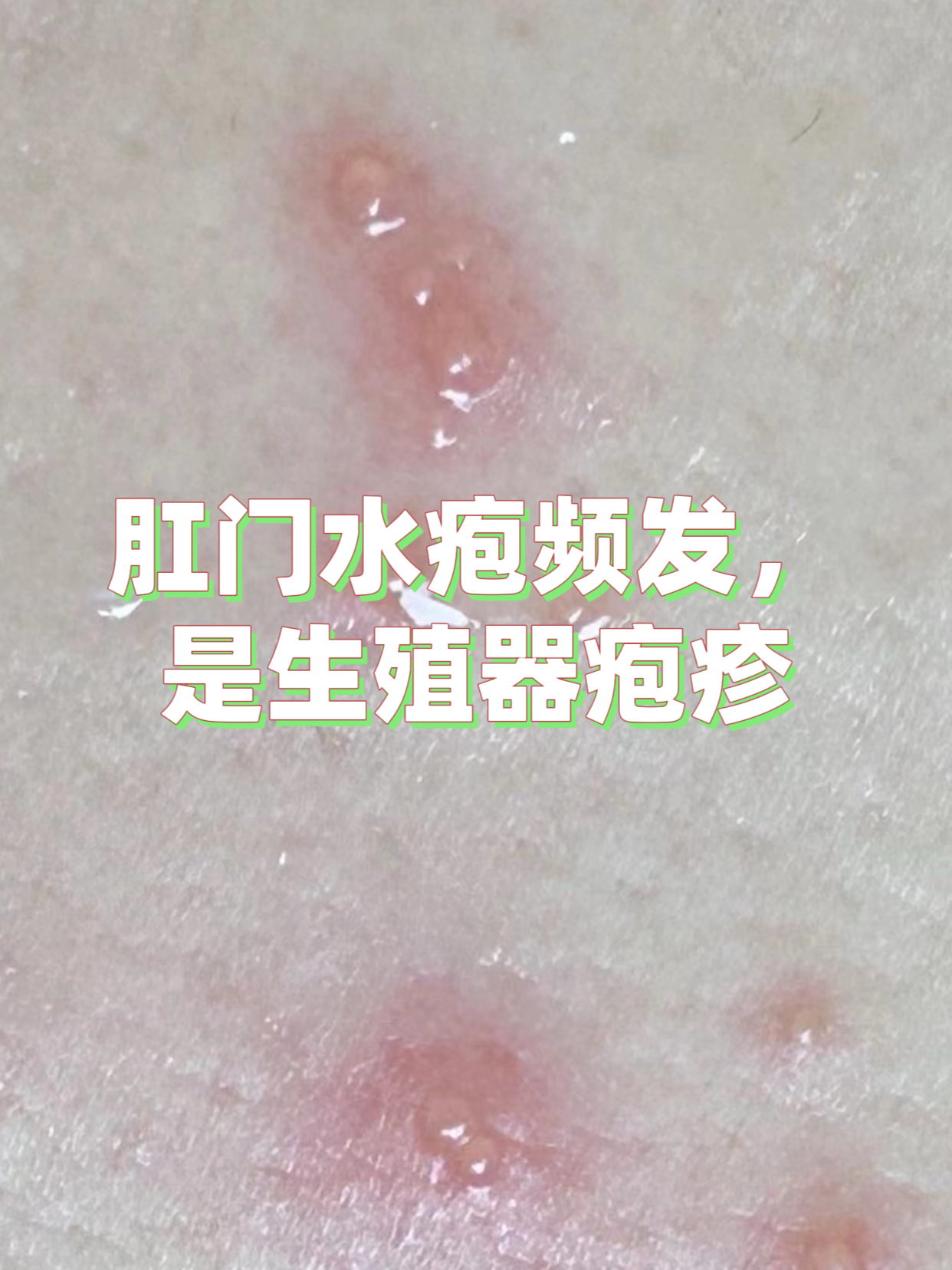 肛门水疱频发,是生殖器疱疹