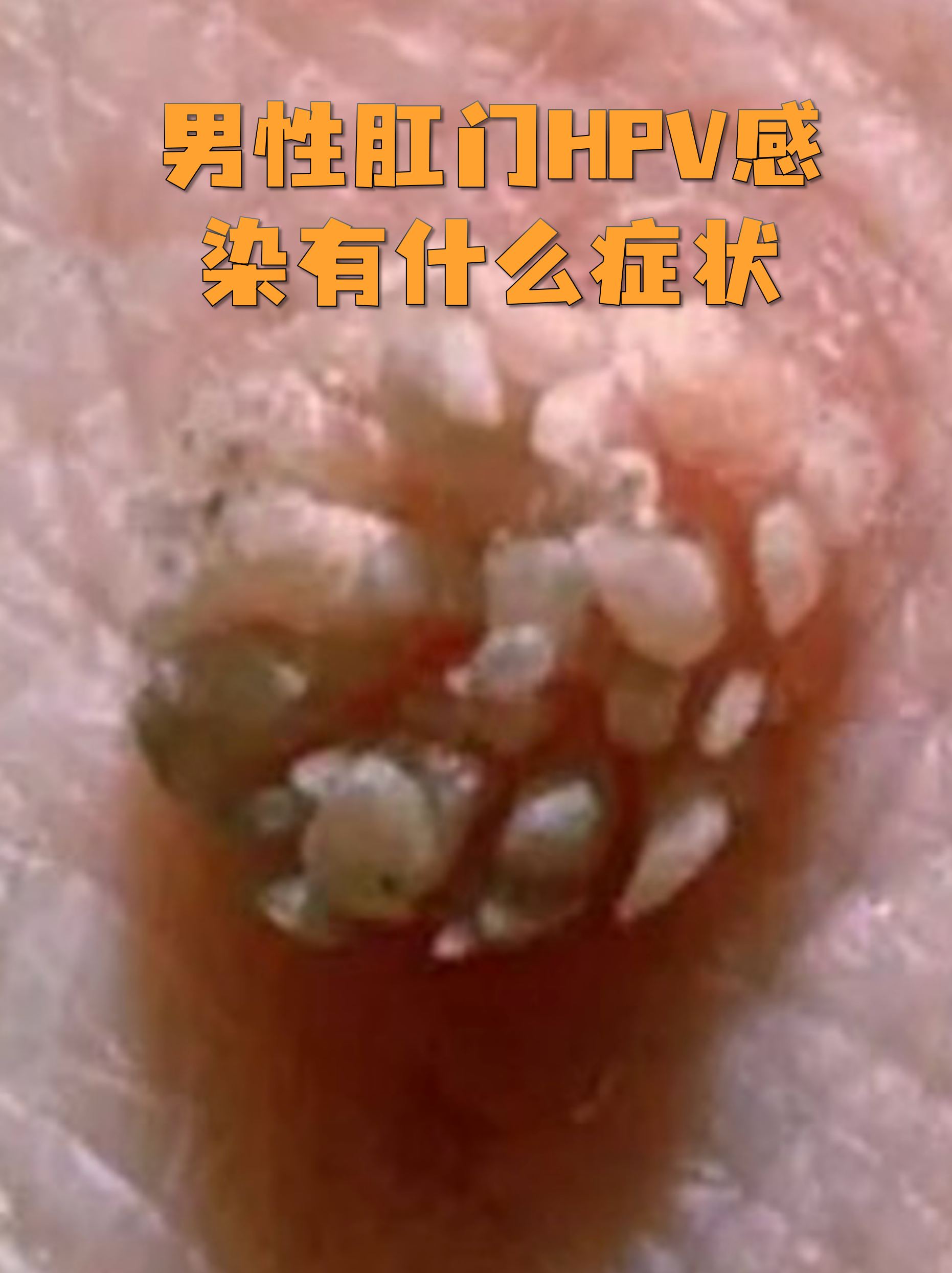 肛门hpv感染症状 轻微不适:感染初期可能仅有肛门轻微瘙痒,灼热