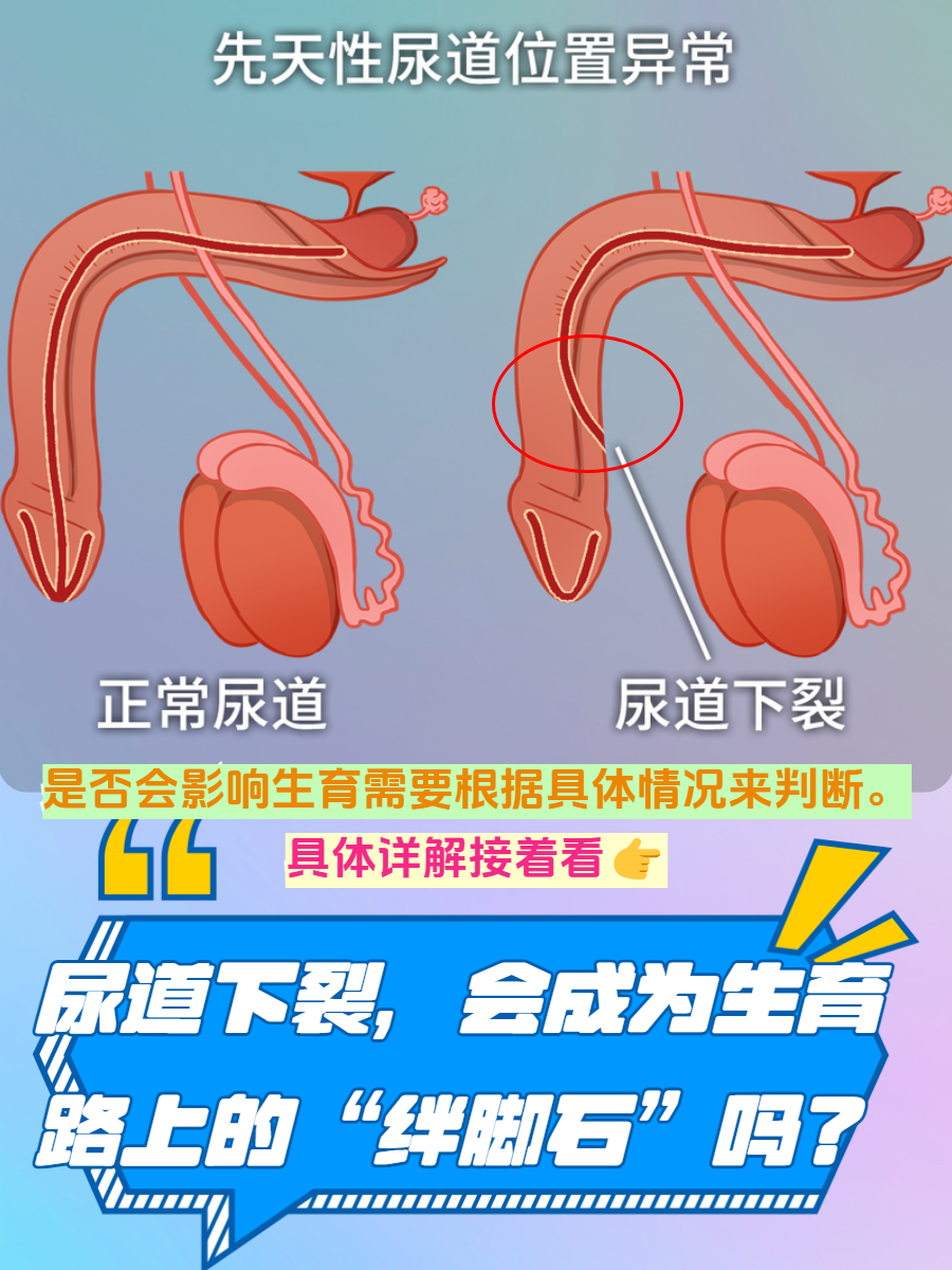 在男性生殖系统的先天性疾病中,尿道下裂并不罕见