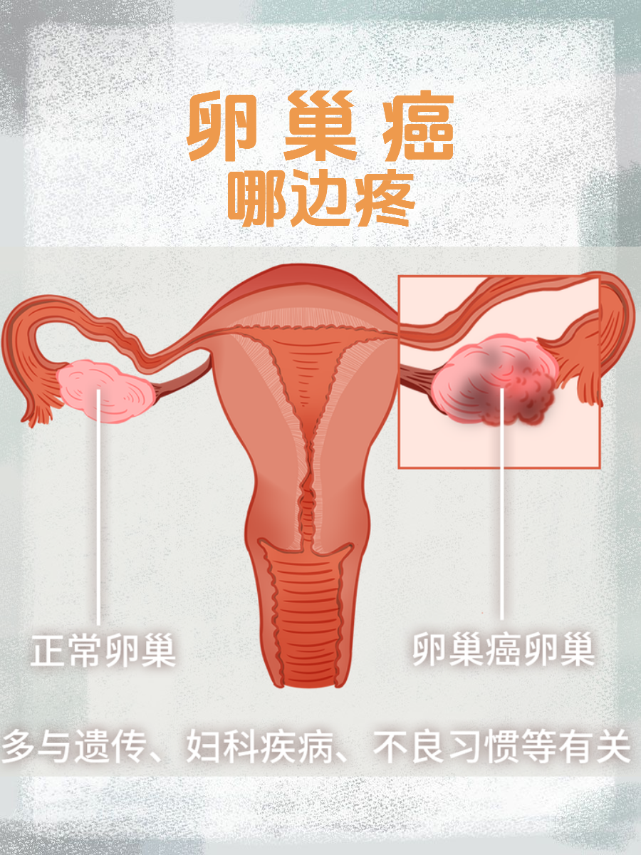 卵巢癌的疼痛位置并非固定不变,它主要取决于肿瘤的生长部位