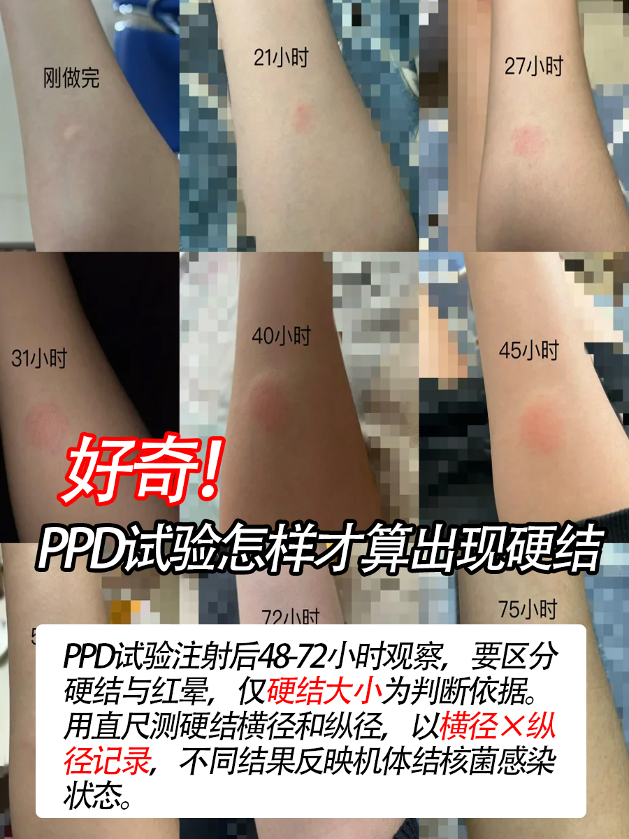ppd试验怎样才算出现硬结