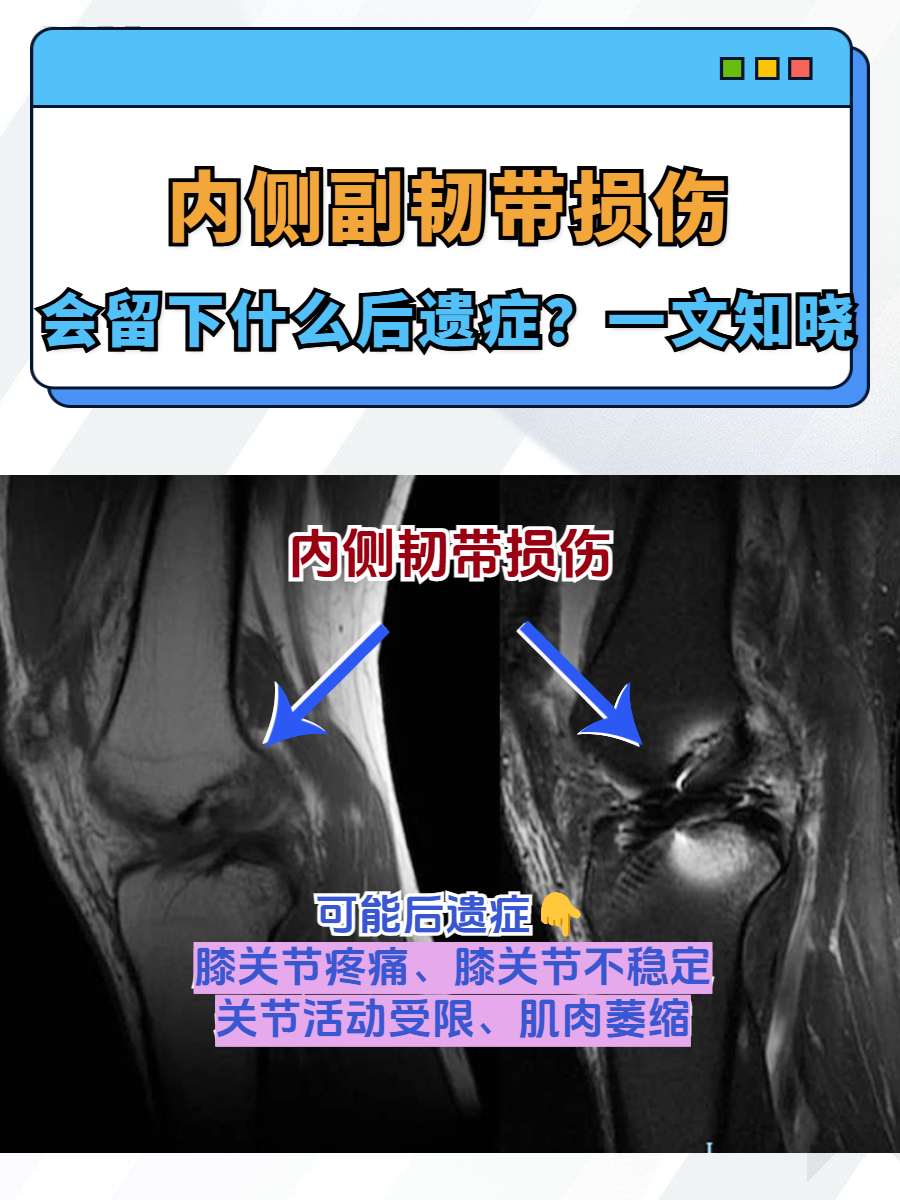 韧带位置图膝盖内侧副韧带位置图内侧副韧带损伤表现膝关节内侧副韧带