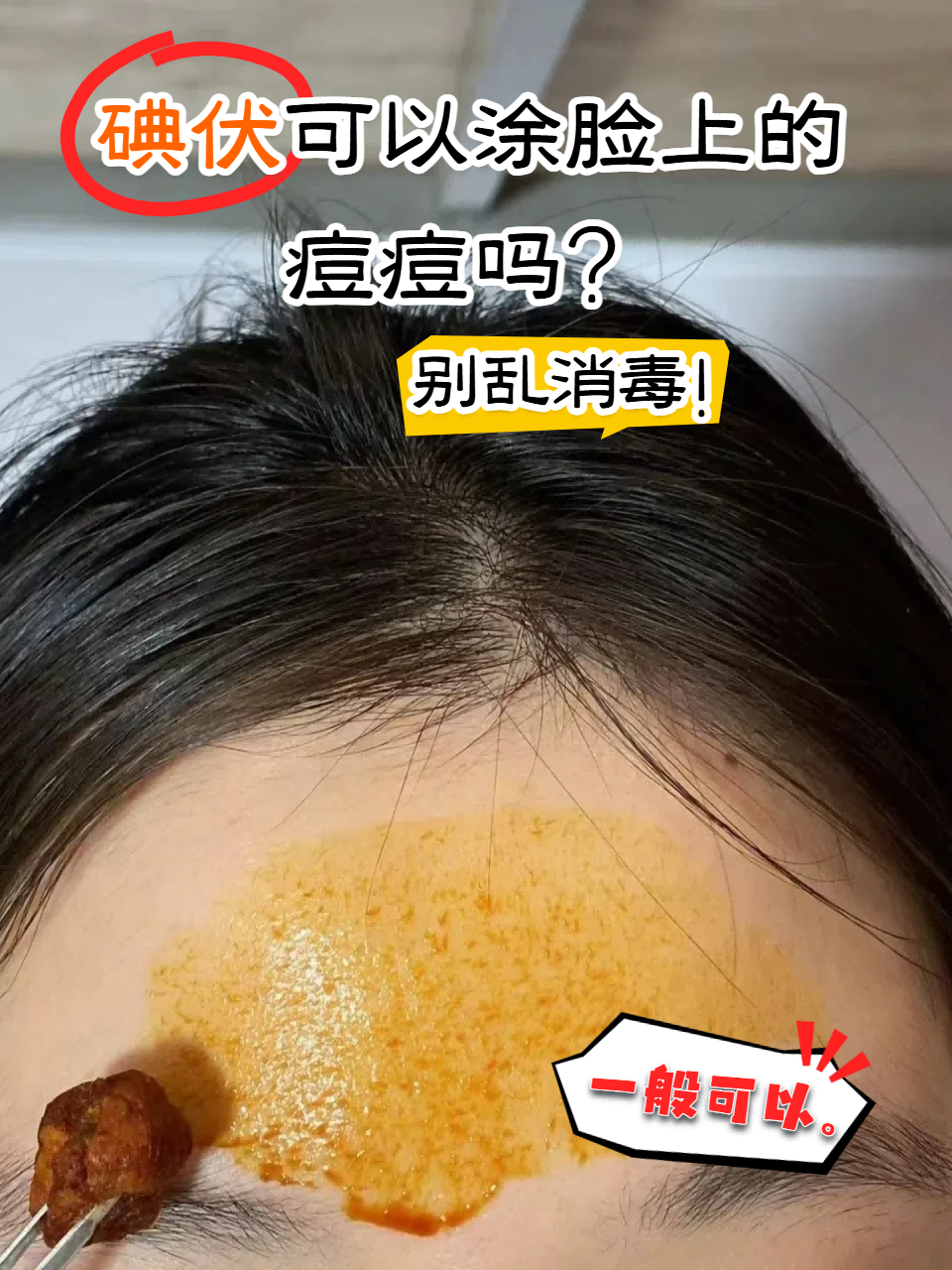 碘伏为什么消毒那么厉害为什么在线 碘伏为什么消毒那么厉害为什么在线