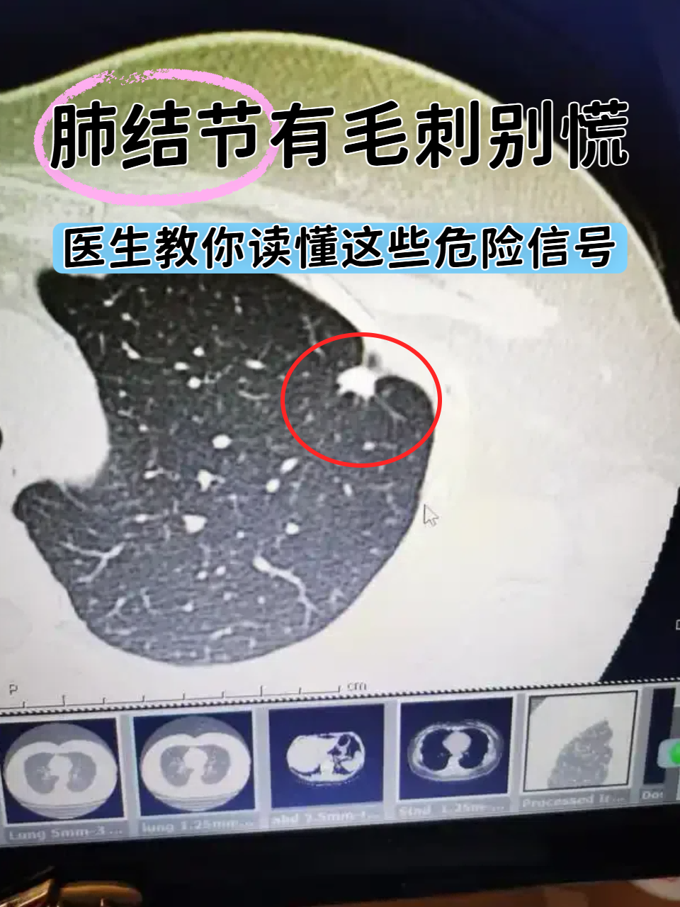 肺结节有毛刺别慌,医生教你读懂这些危险信号
