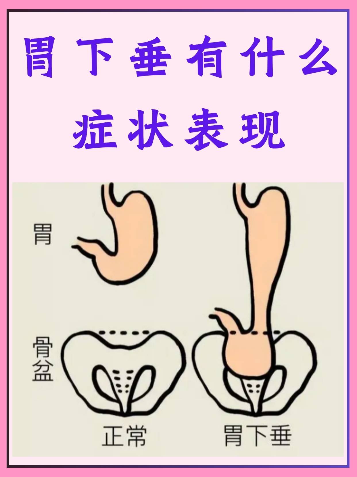 横结肠下垂图片图片