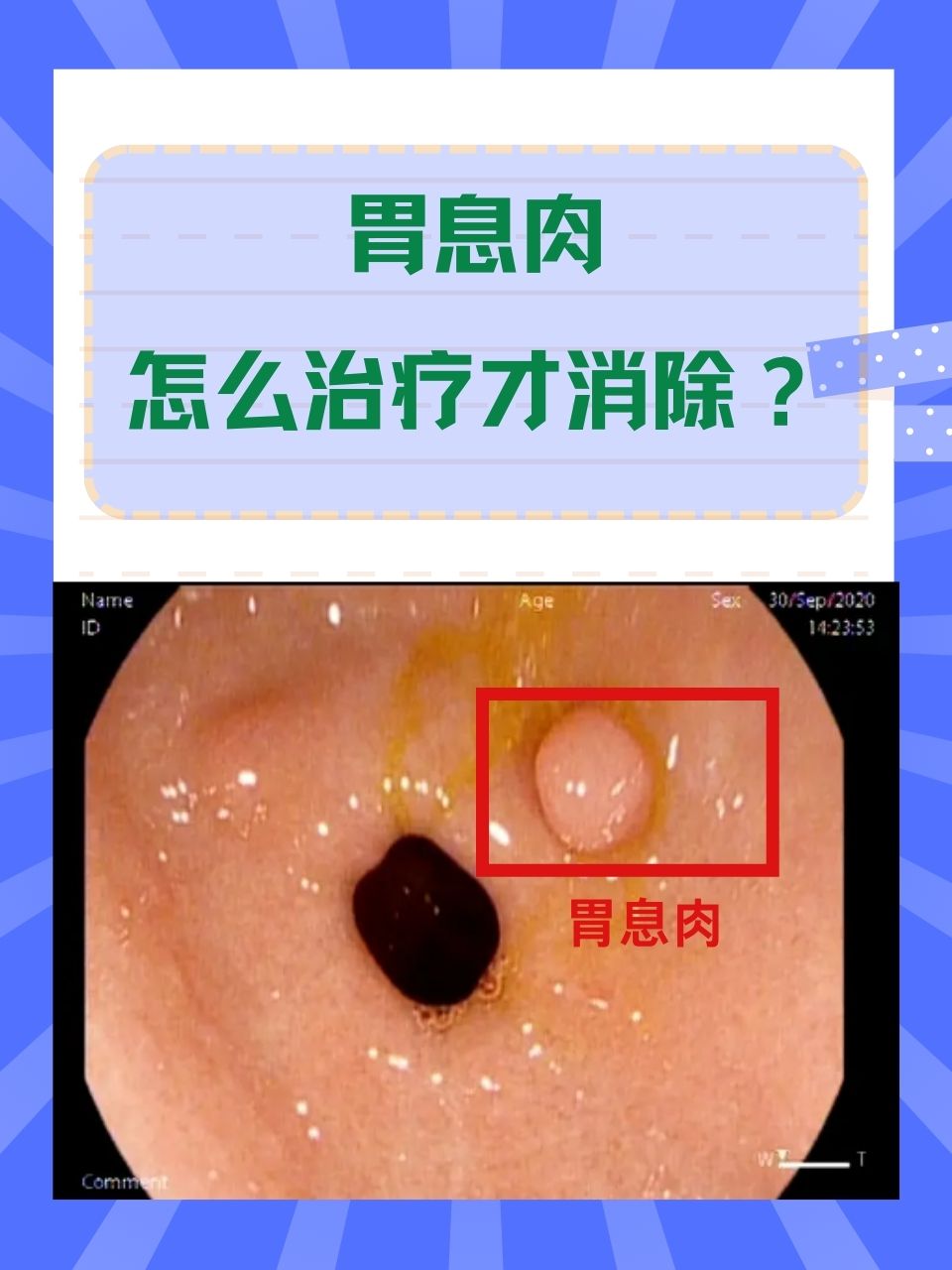 0.8cm有多大图片胃息肉图片