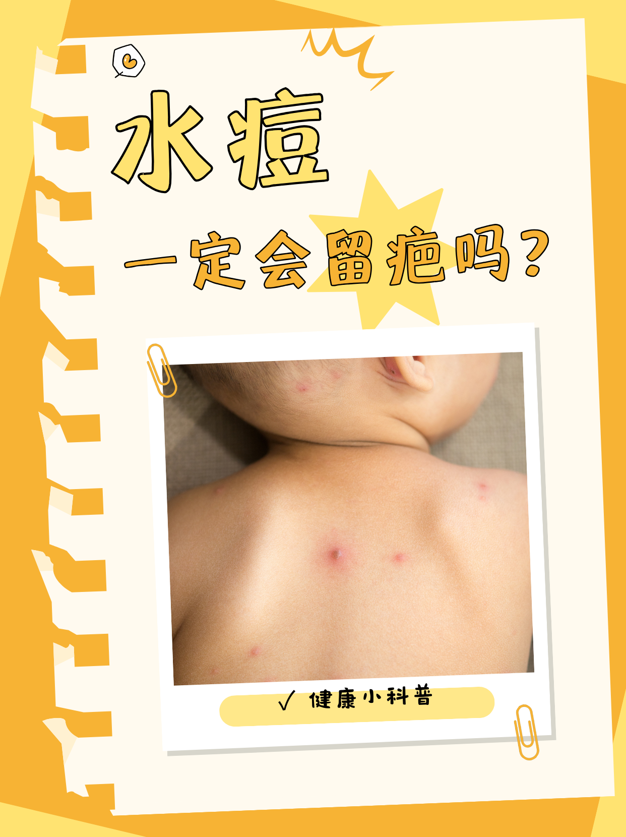 水痘,这个常见的儿科疾病,常常让家长们担忧:水痘过后,孩子皮肤上