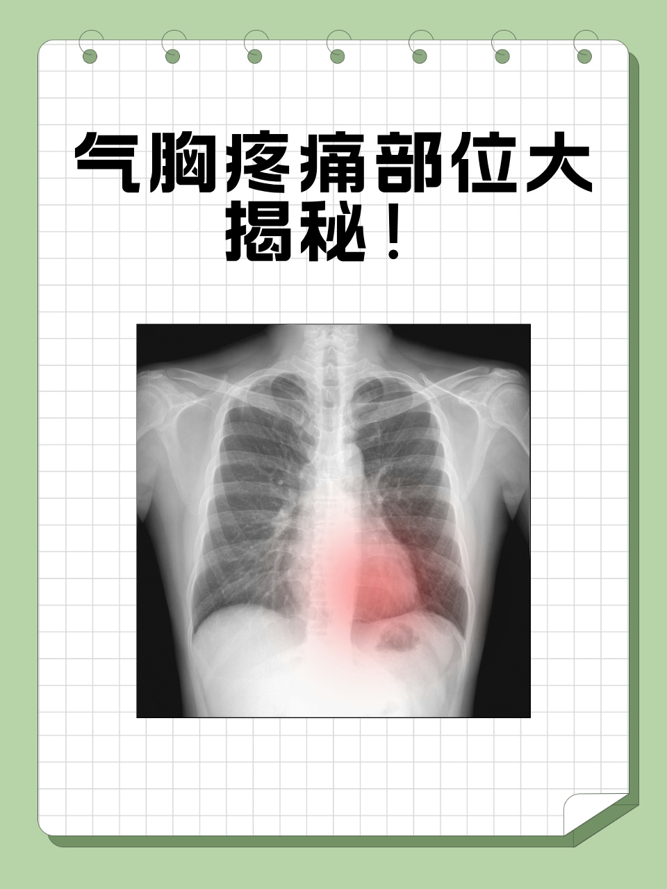 气胸疼痛部位大揭秘!