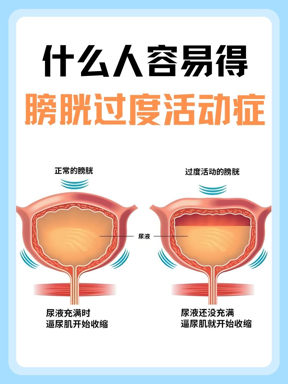 什么人容易得膀胱过度活动症  膀胱过度活动症(oab)是一种常见的泌尿