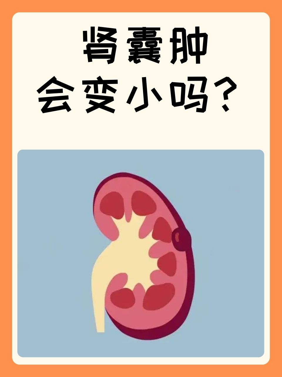 为什么会肾囊肿 为什么会肾囊肿