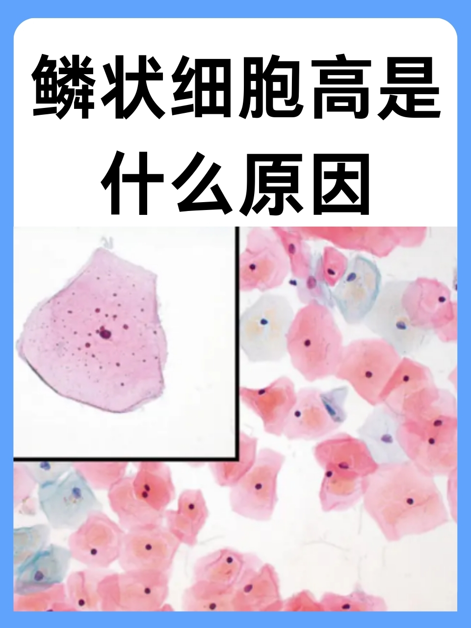 正常鳞状细胞鳞状细胞图片肺泡毛细血管内出现鳞状上皮细胞和粘液请帮