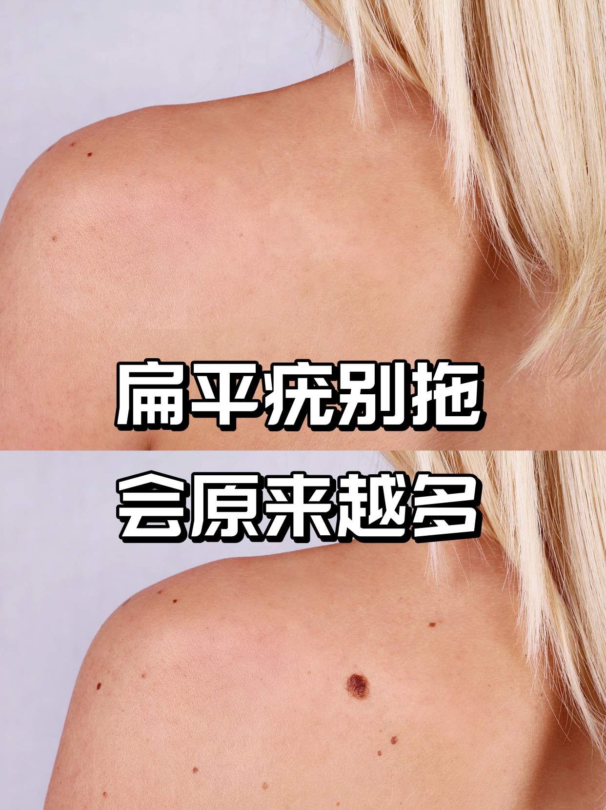 皮肤乳头状瘤是什么病图片